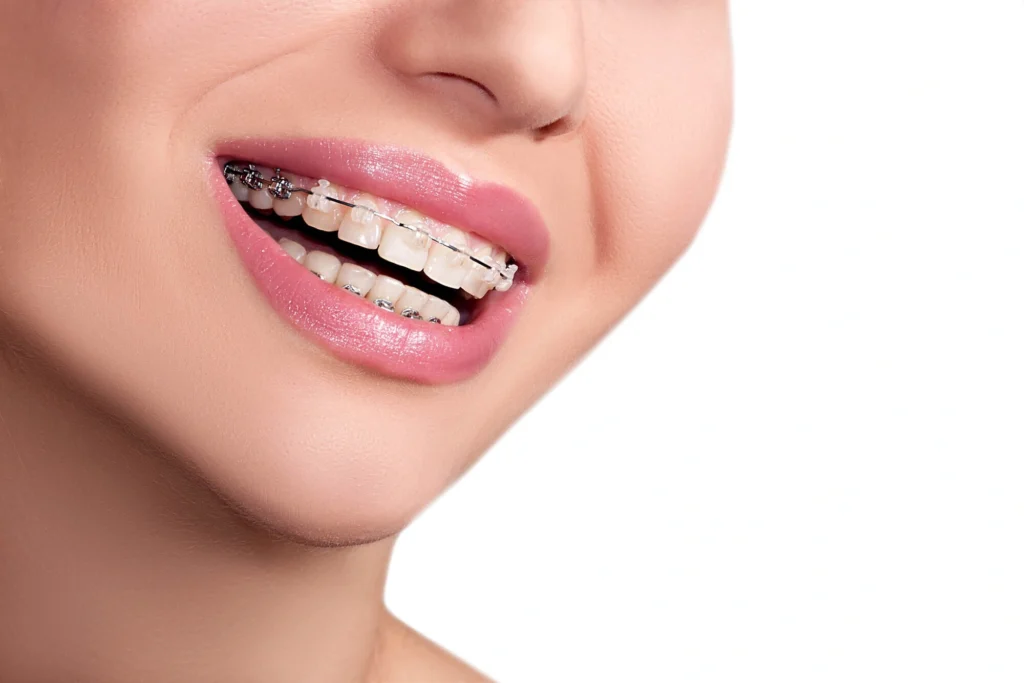 affordable palm beach orthodontics