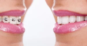 before and after braces west palm beach