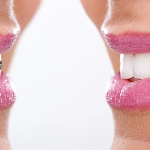 before and after braces west palm beach
