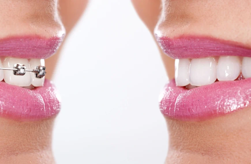 before and after braces west palm beach