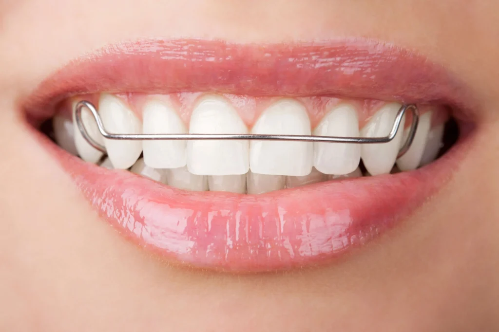 after braces west palm beach