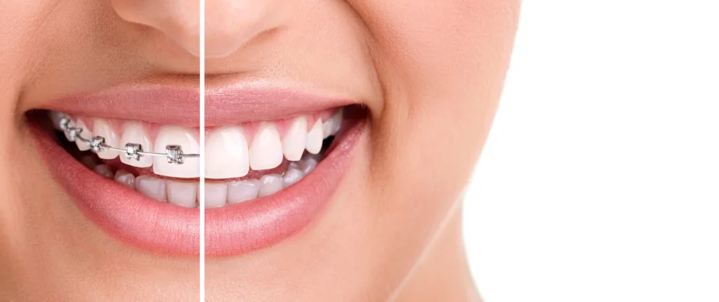 Healthy smile with braces by best orthodontist for adults near you
