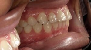 240047 - BONITA ROACHE - Initial - Intraoral Right