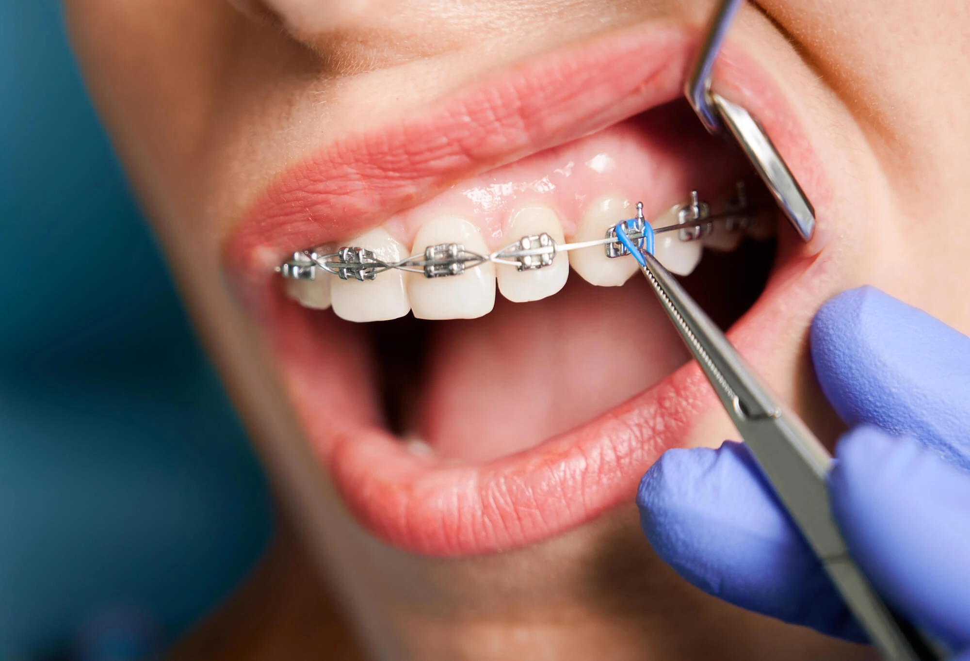 Orthodontic Treatment Comparing Ceramic Braces vs Metal Braces