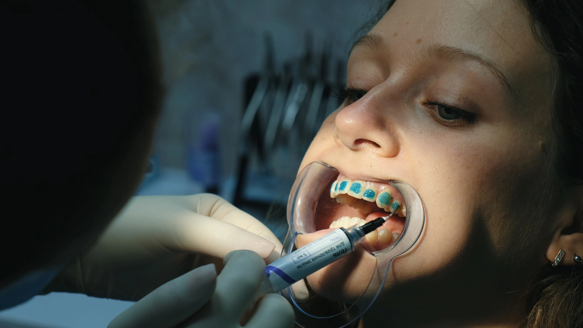 Orthodontist West Palm Beach Applying Braces During Treatment