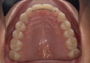 240047 - BONITA ROACHE - Final - Occlusal Upper