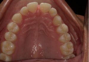 240047 - BONITA ROACHE - Initial - Occlusal Upper