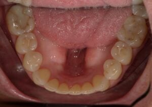 250102 - Cheryl Algeria - Final - Occlusal Lower