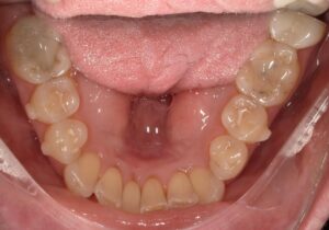 250102 - Cheryl Algeria - Initial - Occlusal Lower