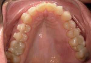 250102 - Cheryl Algeria - Initial - Occlusal Upper