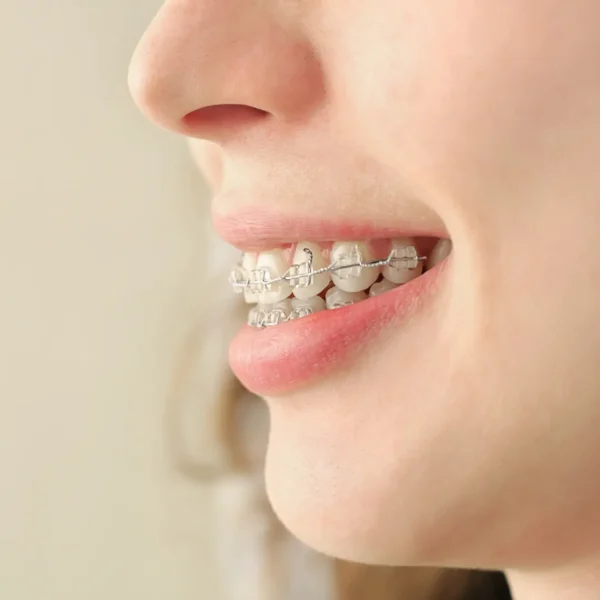 Girl-Smiling-with-Braces-at-Palm-Beach-Orthodontics