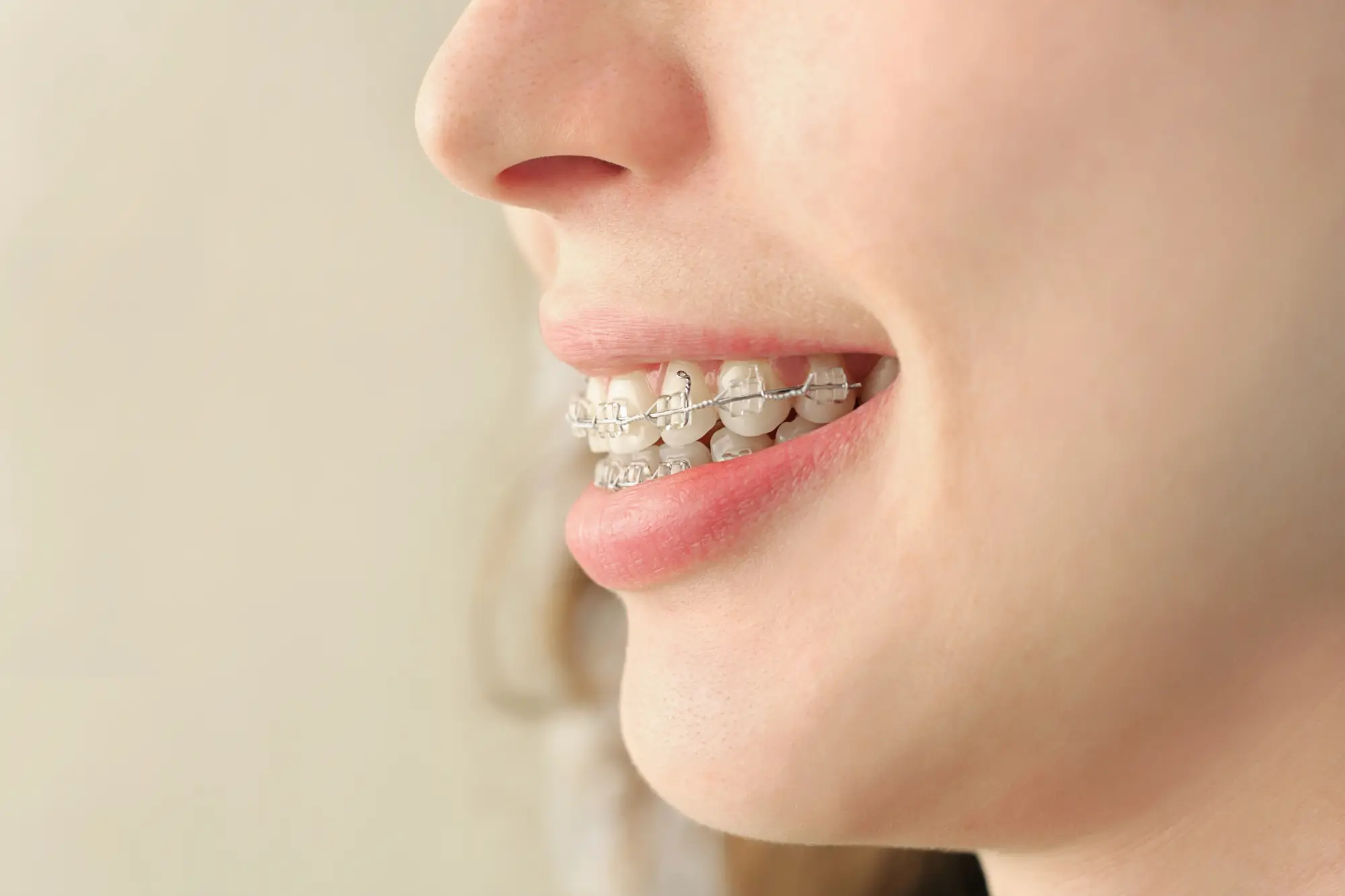 Girl-Smiling-with-Braces-at-Palm-Beach-Orthodontics
