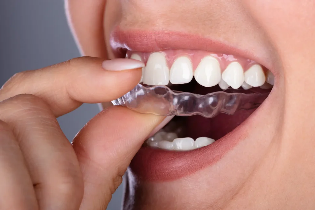 Clear Aligners with Invisalign in West Palm Beach