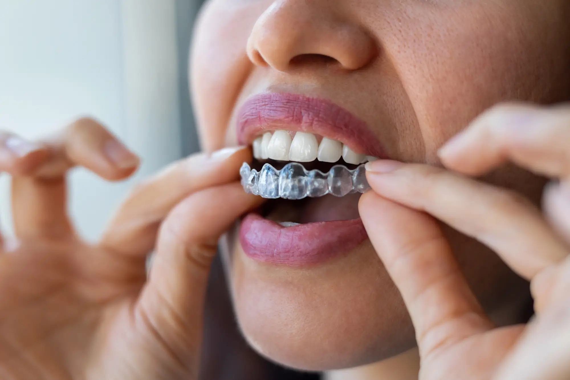 Close-up of Invisalign Mandibular Advancement clear aligner.