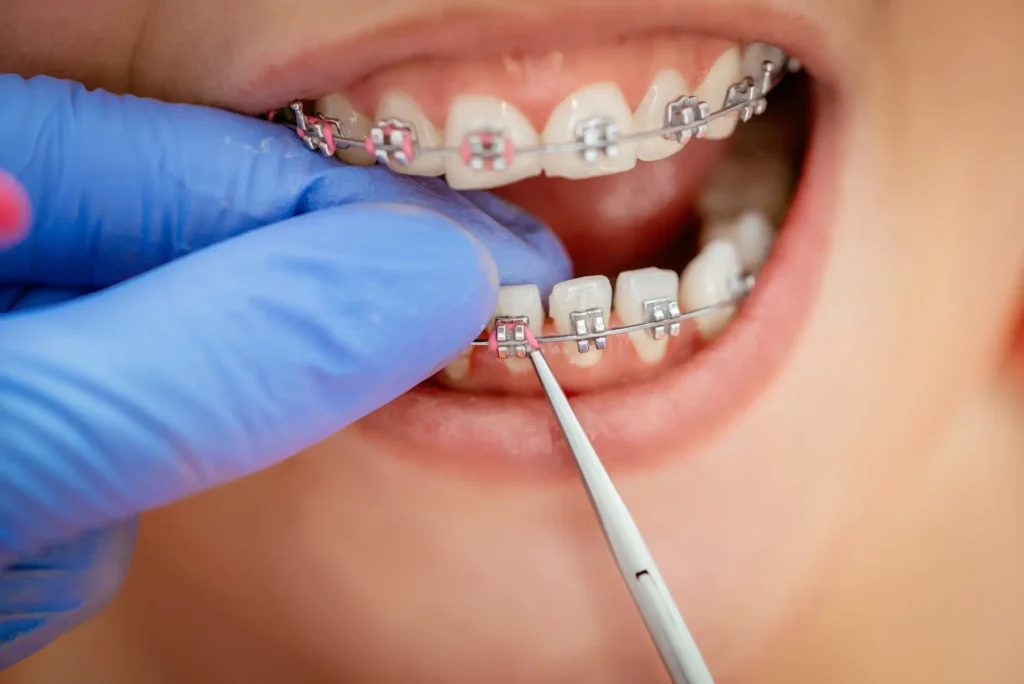 Orthodontist Palm Beach Gardens checking braces brackets.